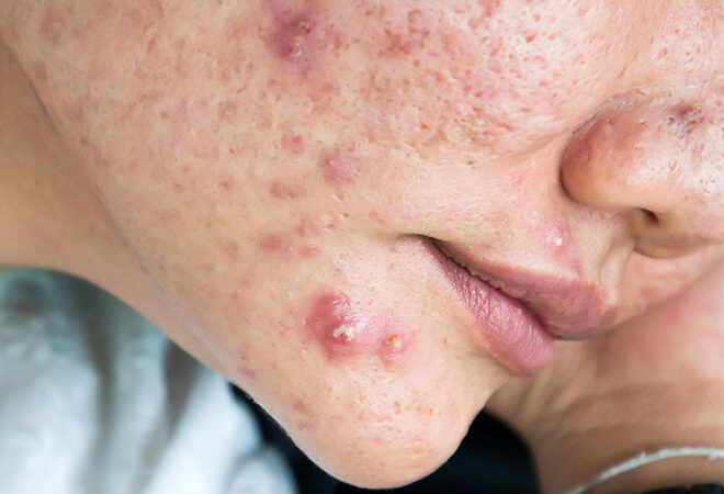 Understanding Pimples: Causes, Prevention, and Effective Treatments