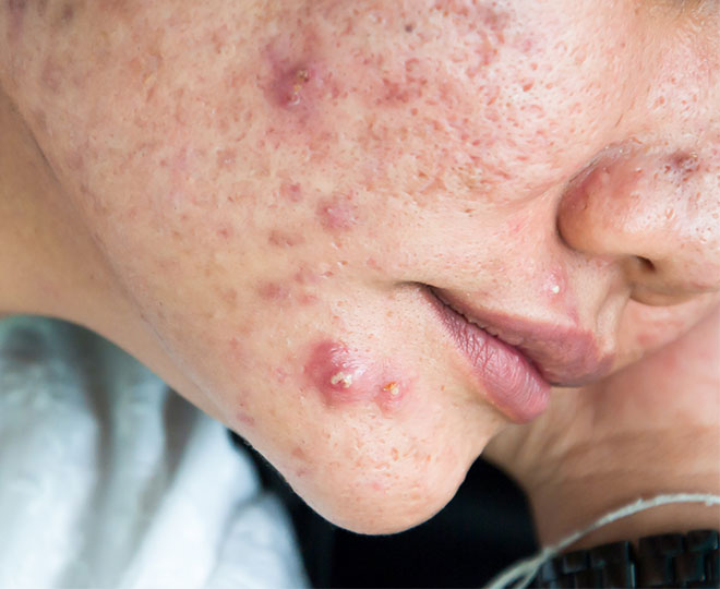 Understanding Pimples: Causes, Prevention, and Effective Treatments