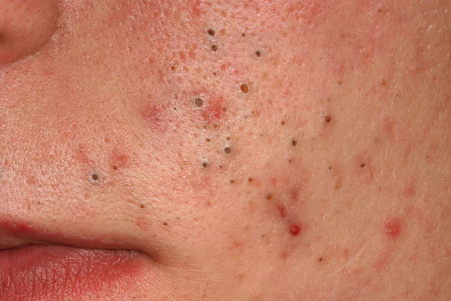 Understanding Pimples: Causes, Prevention, and Effective Treatments