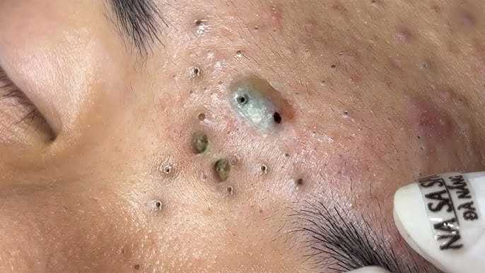 Summarize What is blackheads? How to remove, prevention and treatment