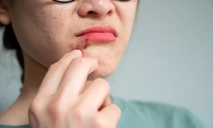 Cold Sores (Fever Blisters)