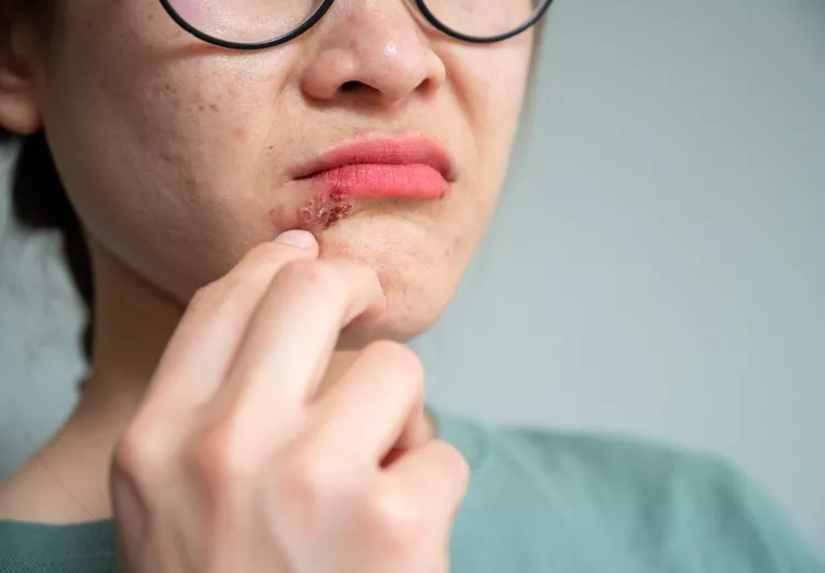 Cold Sores (Fever Blisters)