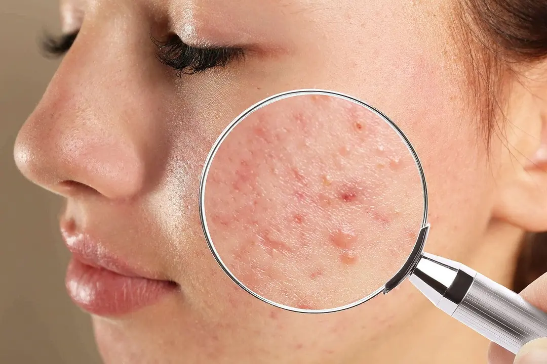 Understanding Pimples: Causes, Prevention, and Effective Treatments